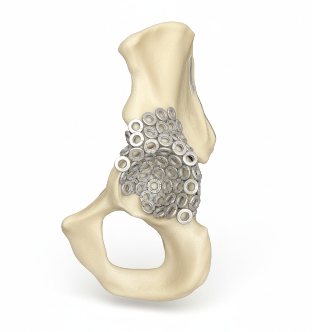 Titanium mesh with pelvic bone